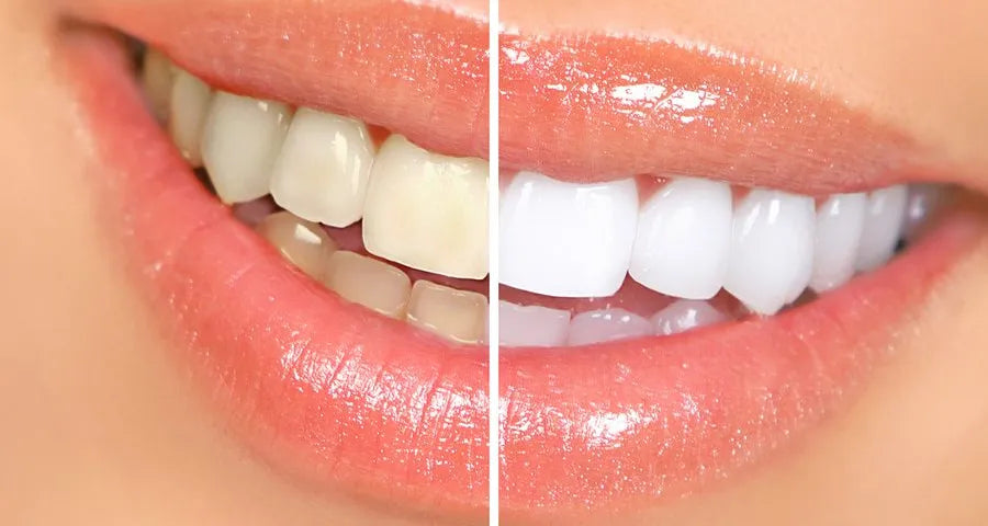 30 minutes cosmetic teeth whitening treatment