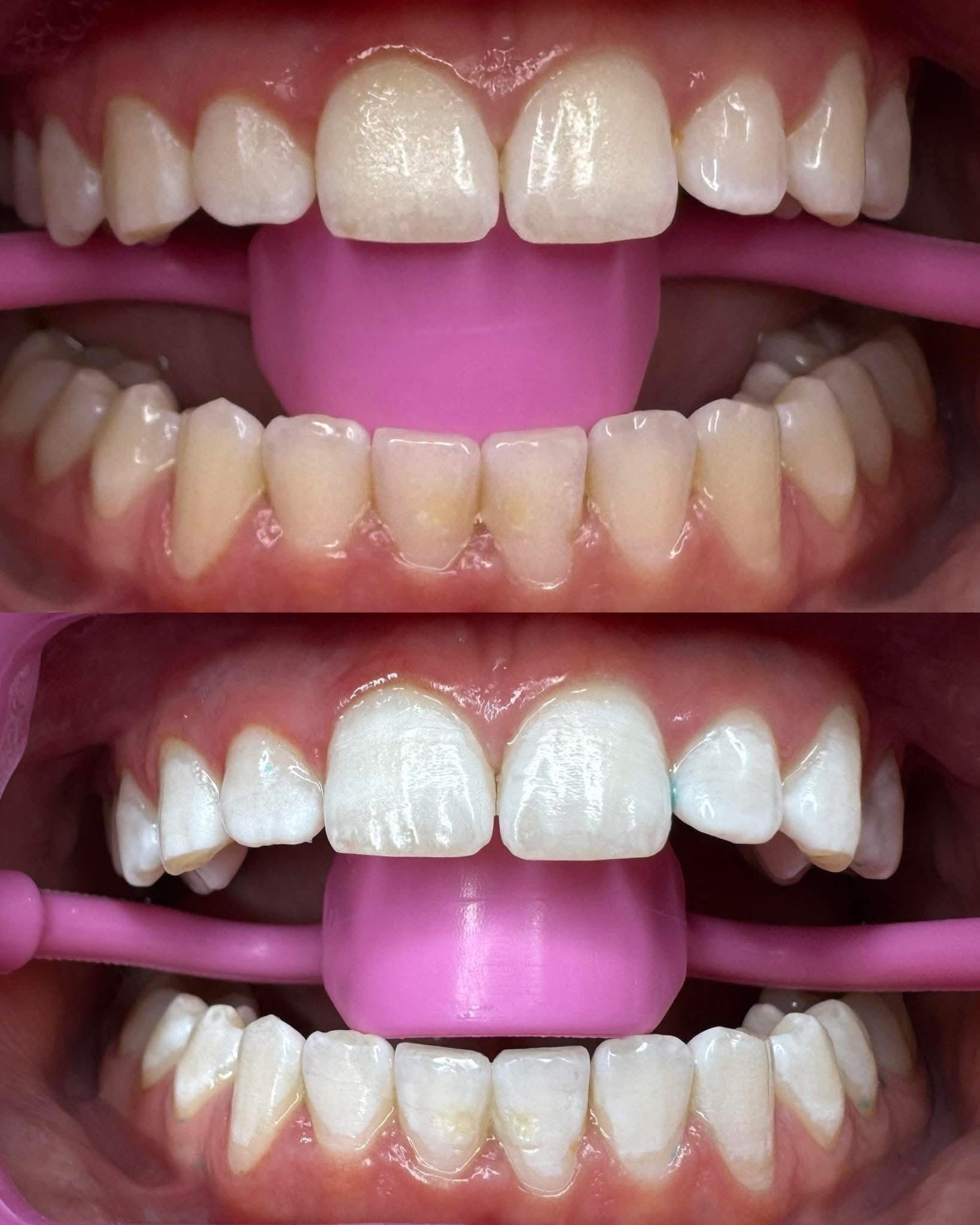 Advance Whitening 60Mins