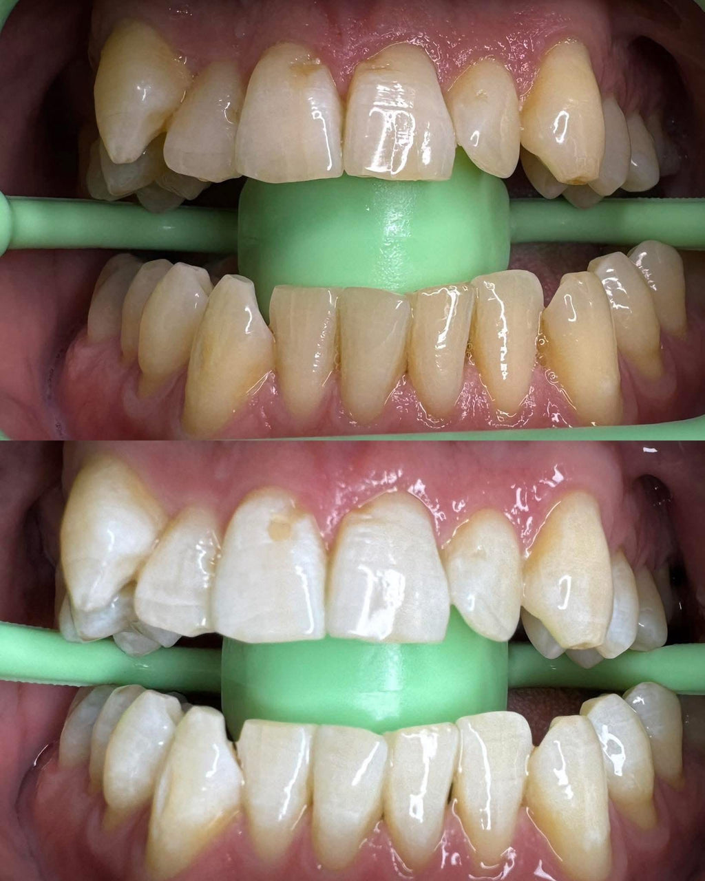Advance Whitening 60Mins