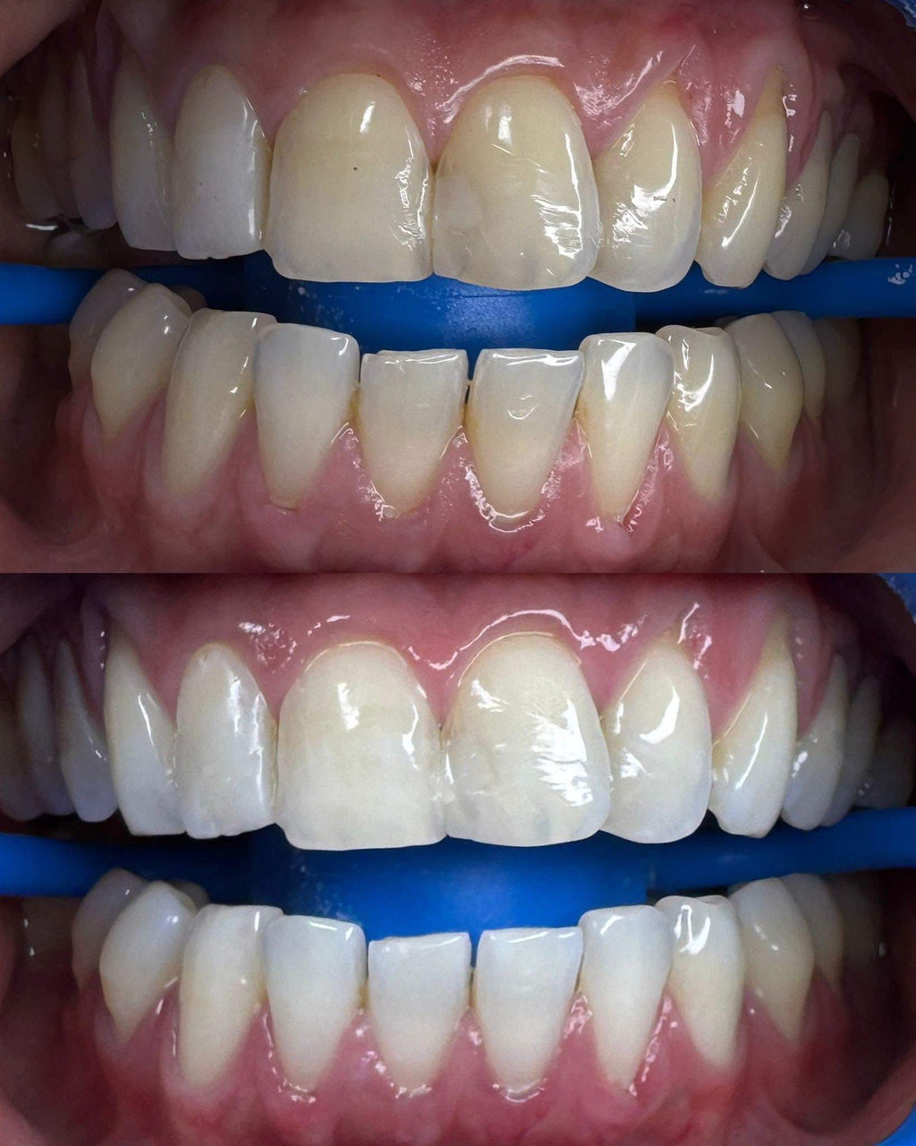 Advance Whitening 60Mins