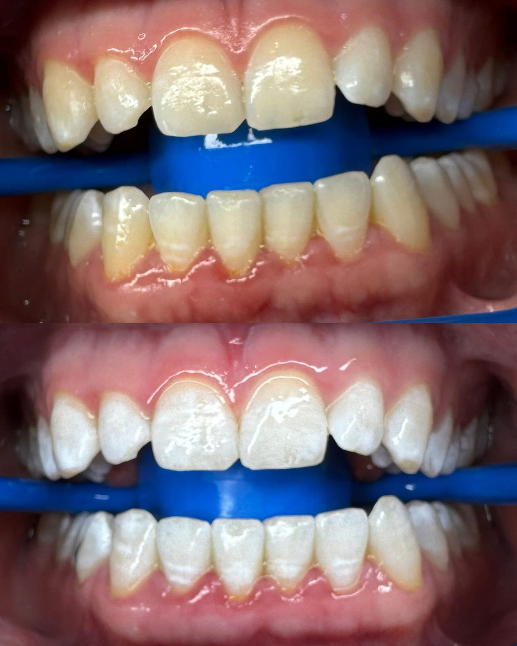 Advance Whitening 60Mins