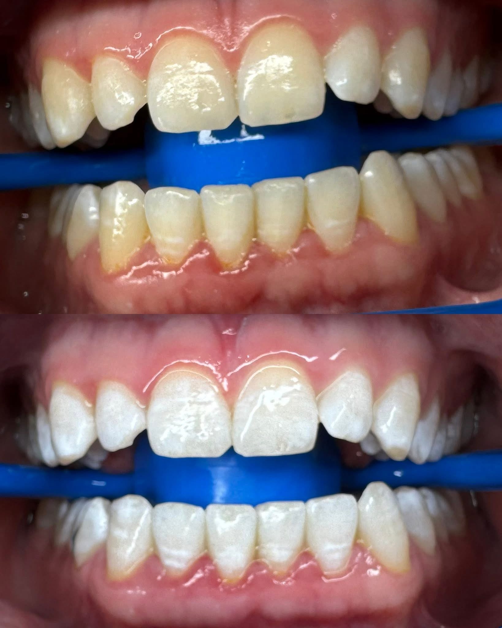 Advance Whitening 60Mins