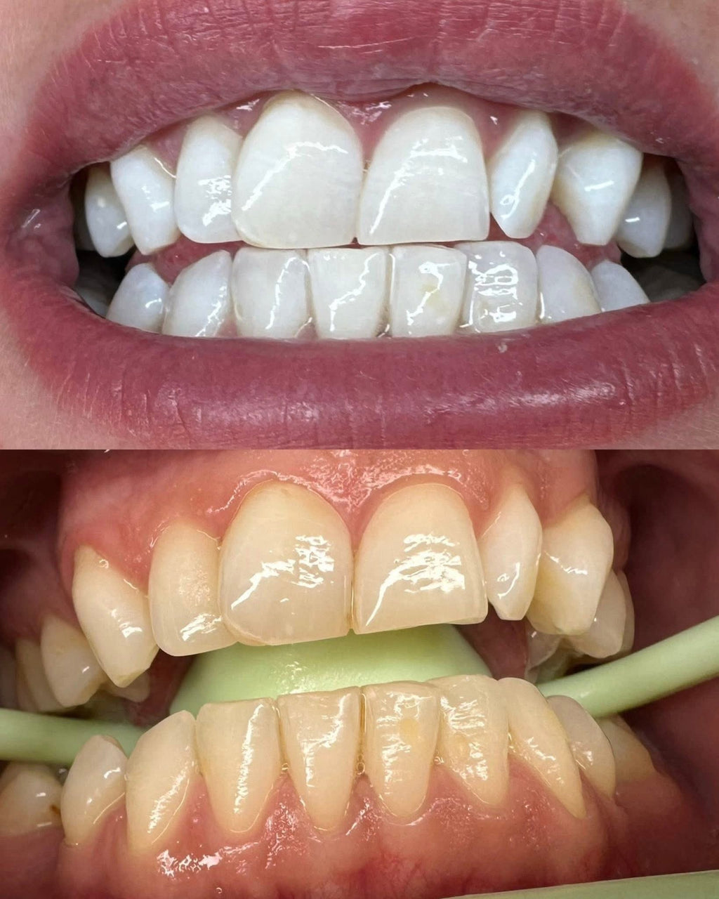 Advance Whitening 60Mins