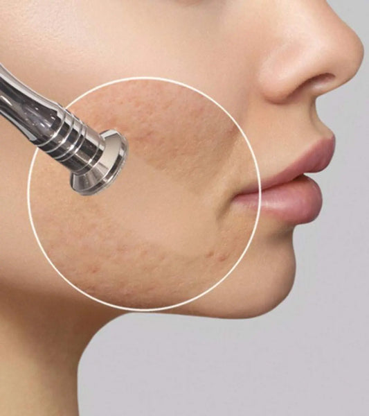 Microdermabrasion
