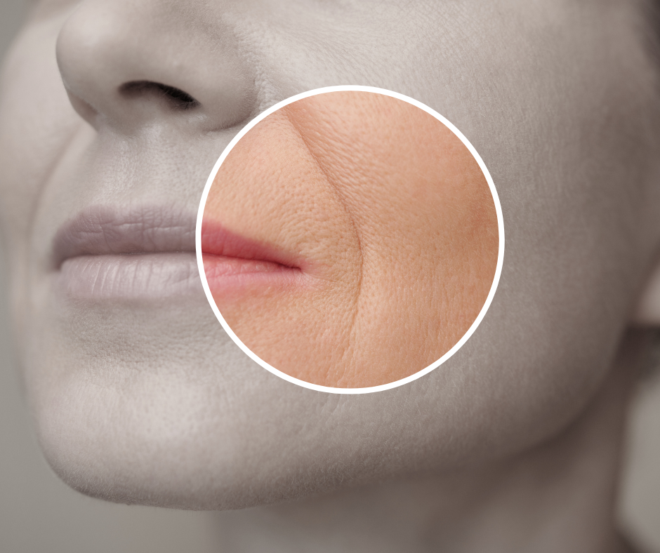 Nasolabial Folds