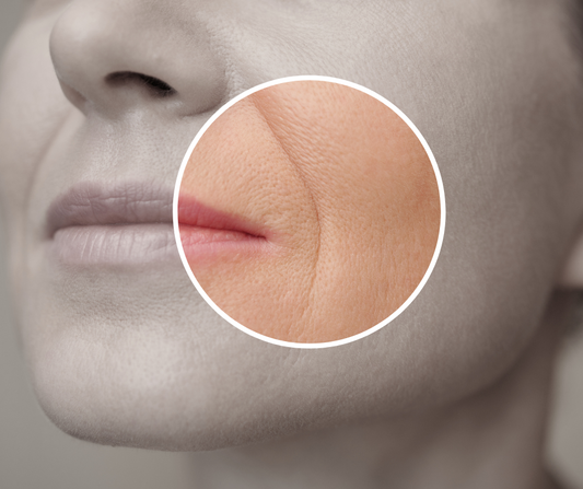 Nasolabial Folds